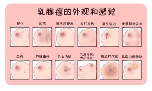 36岁女子胸部疙瘩揭示乳腺癌，早期发现与应对至关重要