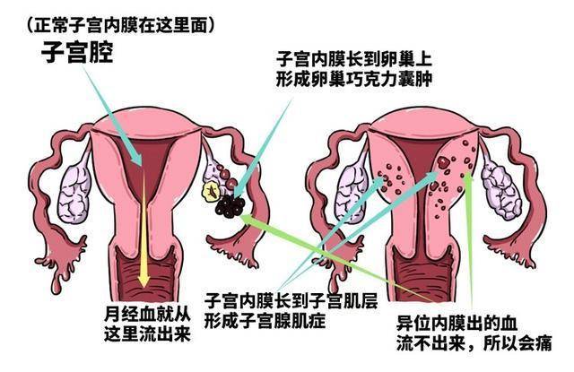 痛经与子宫切除手术，一位年轻女性的故事经历